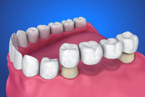 Dental Bridges in Hinjewadi