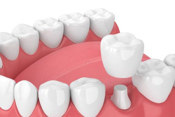 Best Dental Crown Treatment in Hinjewadi