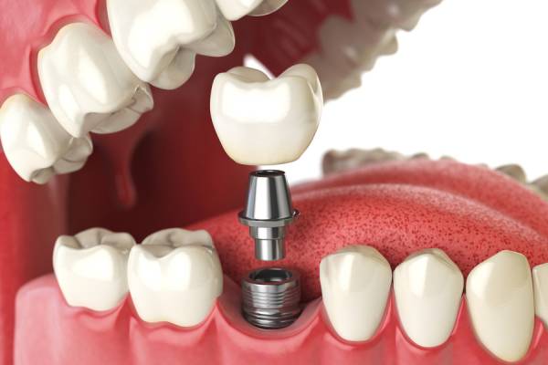 Best Dental Implant Treatment in Hinjewadi