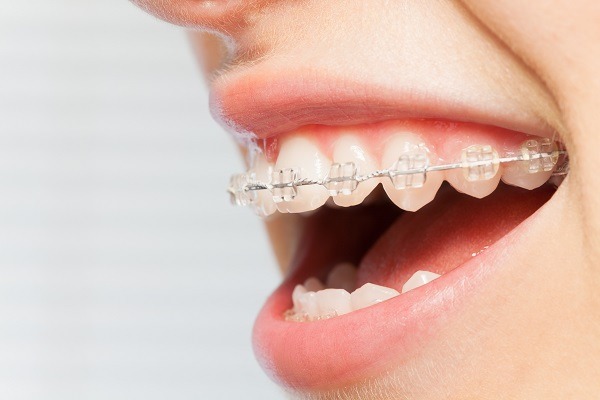 Invisible Aligners Treatment in Hinjewadi