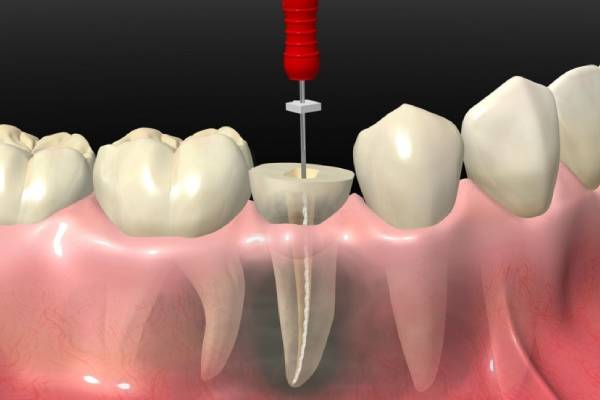 Re-Root Canal Treatment in Hinjewadi | Dr. Vikas Pakhare