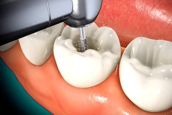 Best Root Canal Treatment in Hinjewadi | Dr. Vikas Pakhare