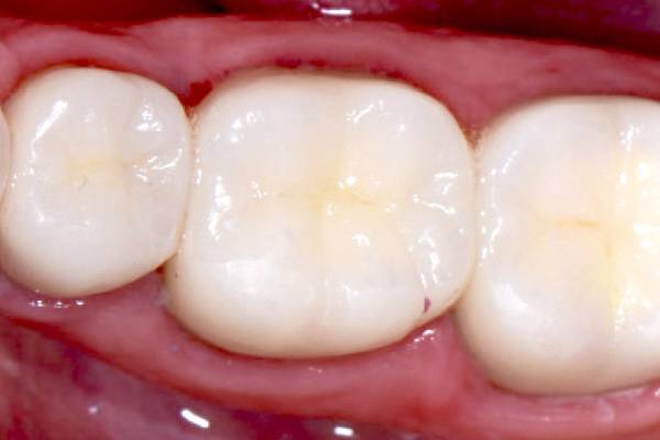 Tooth Colored Fillings in Hinjewadi | Dr. Vikas Pakhare