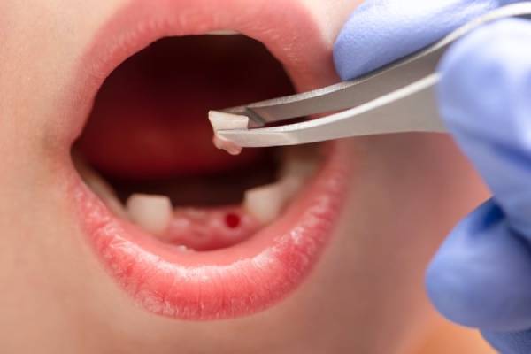 Tooth Extraction Services in Hinjewadi- Dr. Vikas Pakhare