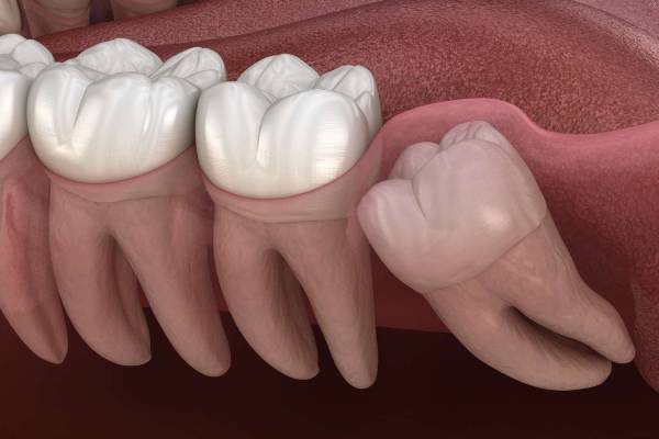 Wisdom Tooth Removal in Hinjewadi | Dr. Vikas Pakhare